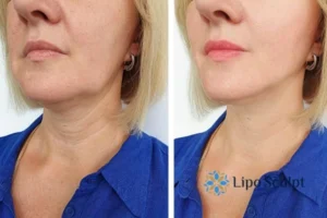 Double chin before and after Hi-Fu treatment 4 Book your double chin treatment Newcastle under Lyme today! We are here to help!