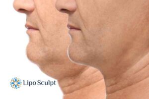 Double chin before and after Hi-Fu treatment 2 Double chin treatment Newcastle under Lyme from Lipo Sculpt - feel more confident today!