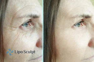 How to Fight Aging Symptoms 2 Do you want to Fight Aging Symptoms Newcastle under Lyme? Contact Lipo Sculpt today!