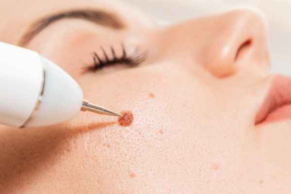 CryoPen: 5 Skin Concerns It May Be Used to Treat 3 What actually happens during a CryoPen treatment Newcastle under Lyme?