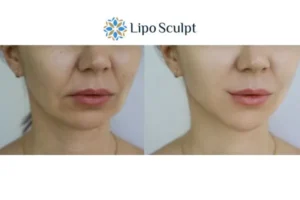 Explaining Total Skin Tightening Treatment And What It Can Do For You 2 Do you want to boost your self confidence? Give Morpheus8 Newcastle under Lyme a try today!