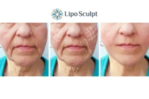 Explaining Total Skin Tightening Treatment And What It Can Do For You 3 Boost your confidence with Morpheus8 Newcastle under Lyme call our team today!