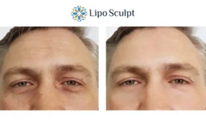 Explaining Total Skin Tightening Treatment And What It Can Do For You 6 Morpheus8 Newcastle under Lyme book in today to find out more!