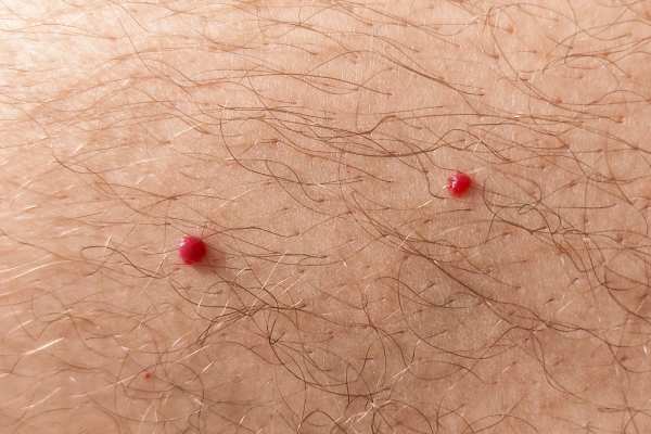 CryoPen: 5 Skin Concerns It May Be Used to Treat 2 cherry angioma removal Newcastle under Lyme