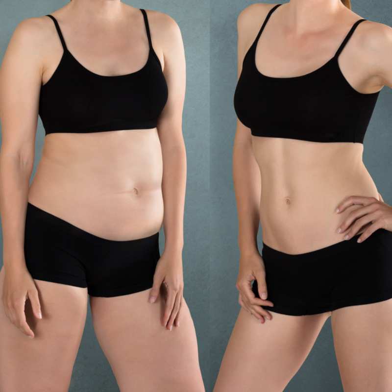 Does Fat Freezing at Home Work? DIY Devices vs Professional Cryolipolysis 2 before and after Cryolipolysis Newcastle under Lyme