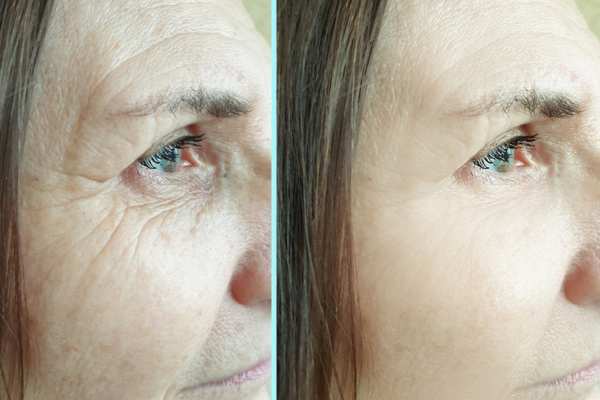 Why Do People Choose HIFU for a Non-Surgical Facelift? 4 How long can HIFU results last Newcastle under Lyme?