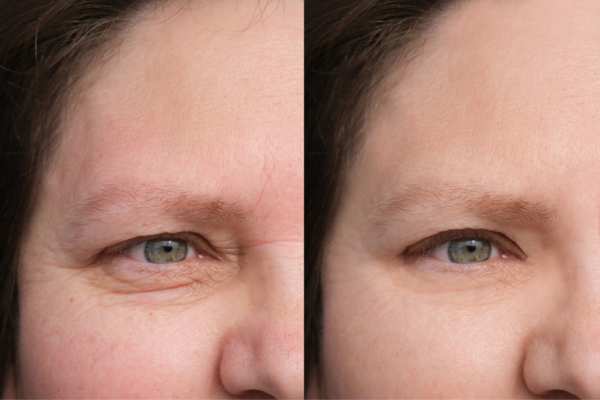HIFU vs Botulinum Toxin: Understanding the Differences 4 How long do HIFU results last Newcastle under Lyme?