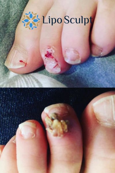 Wart removal customer results from Lipo Sculpt Newcastle under Lyme