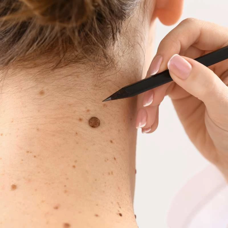 How to Support Your Body During Pregnancy for Faster Postnatal Recovery 5 See our lesion removal prices Newcastle under Lyme - call today for a free quote