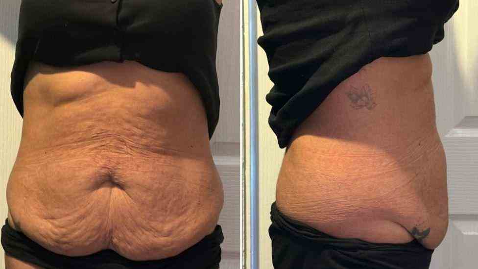 Lost the Weight but Not the Loose Skin? What You Should Know 1 Is It Definitely Loose Skin Newcastle under Lyme?