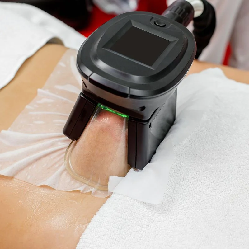 Fat Freezing treatment Newcastle under Lyme